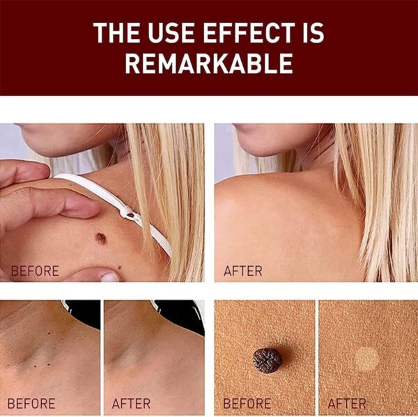 Liquid Warts Tags & Moles Remover - Image 3
