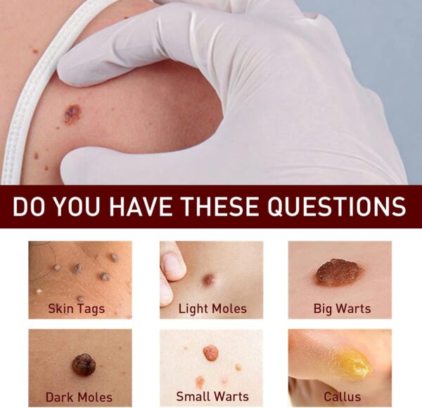 Liquid Warts Tags & Moles Remover - Image 5
