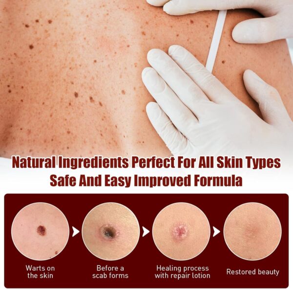 Liquid Warts Tags & Moles Remover - Image 2
