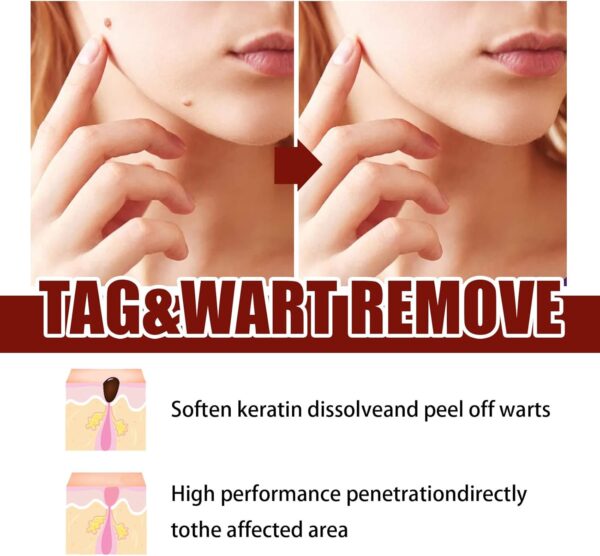 Liquid Warts Tags & Moles Remover - Image 4