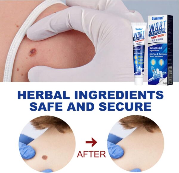Wart Remover Ointment Herbal 20g - Image 7