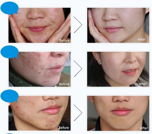 BIOAQUA Acne Anti-Wrinkle Treatment Removal Cream - Image 2