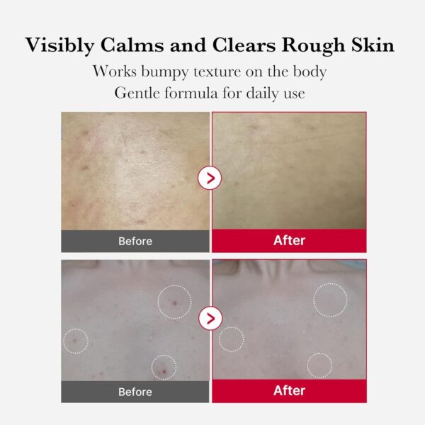 Medicube Red Acne Body Peeling Shot - Image 6